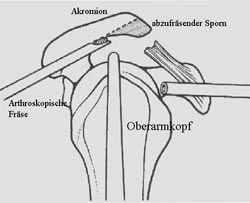 Technik der Akromioplastik (ASAD)