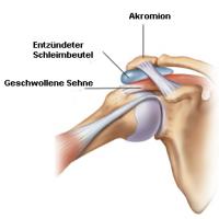 Impingementsyndrom, Zeichnung