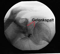 Nach Dilatation der Gelenkkapsel