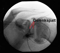 Vor Dilatation der Gelenkkapsel