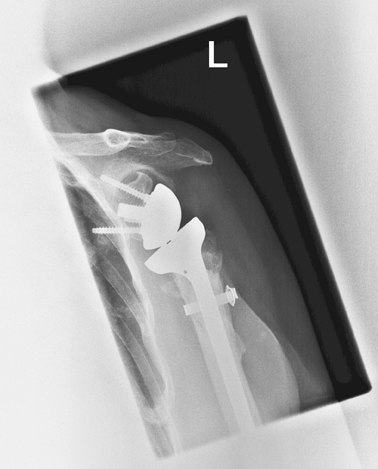 Wechseloperation bei Prothesenlockerung